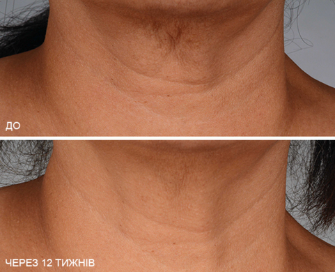 Крем для шиї та зони декольте iS Clinical NeckPerfect Complex